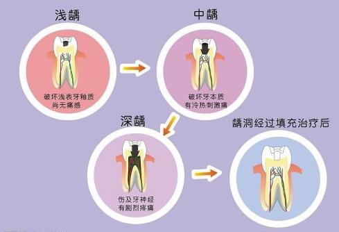 根管治疗4次哪次痛