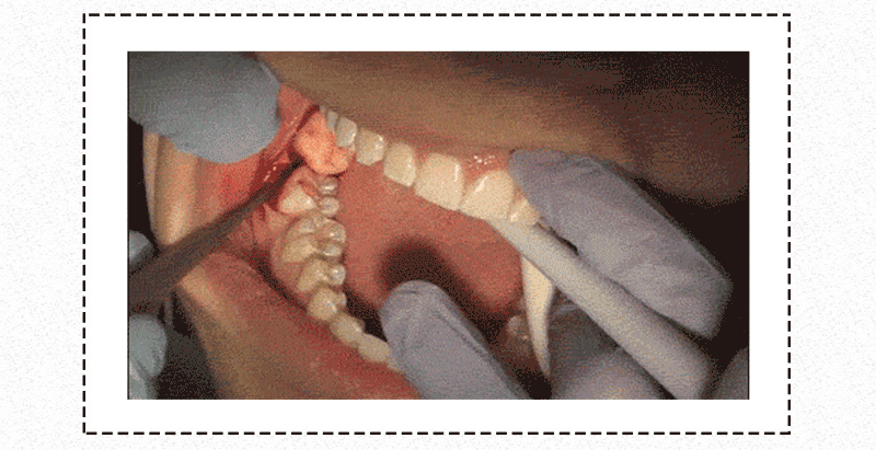 上颚智齿拔出后洞会长好吗—奇迹智齿拔出后洞神奇愈合
