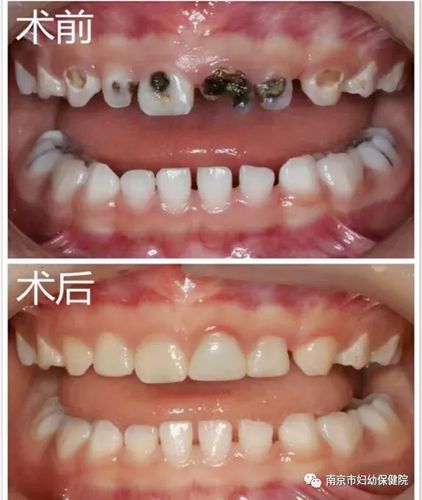 牙根补牙过程图解—从空洞到完美牙齿