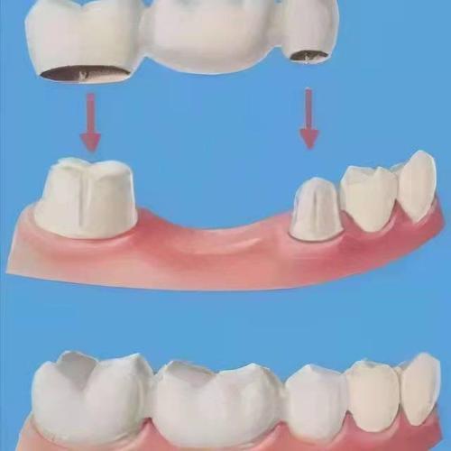 固定桥补牙方法能维持多久