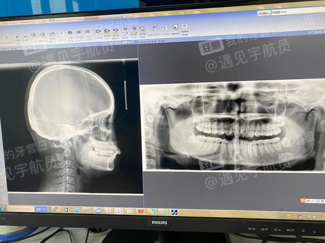 牙套竟然影响CT检查