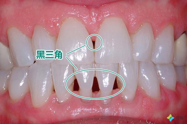 牙龈萎缩不再困扰神奇方法帮你轻松恢复牙龈健康