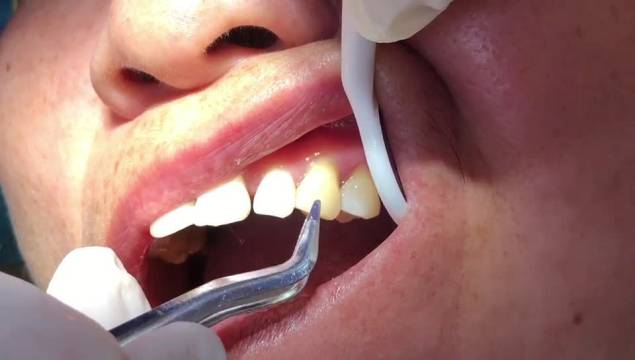 松动的原理是利用激光的能量作用于牙齿周围的组织,刺激牙槽骨的再生