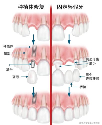 种植牙修复步骤视频