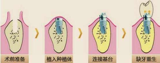 固定桥补牙方法能维持多久