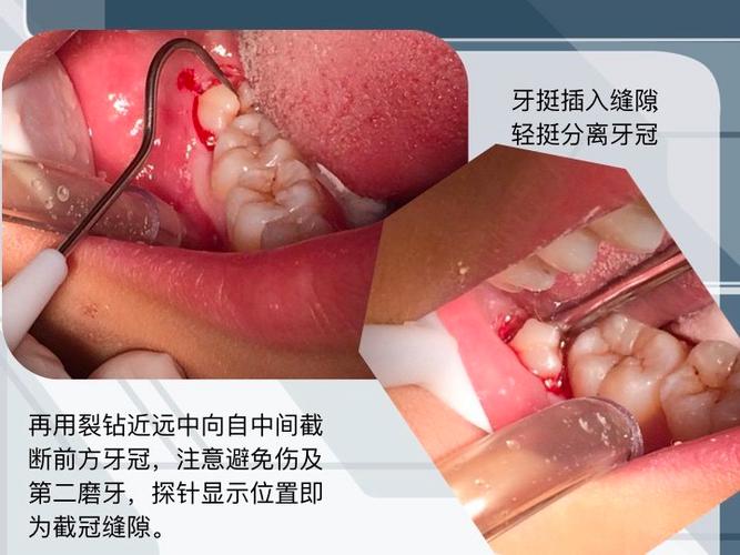 微创救援轻松拔牙不痛苦