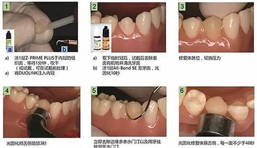 烤瓷牙树脂水门汀粘结剂怎么用—解密烤瓷牙