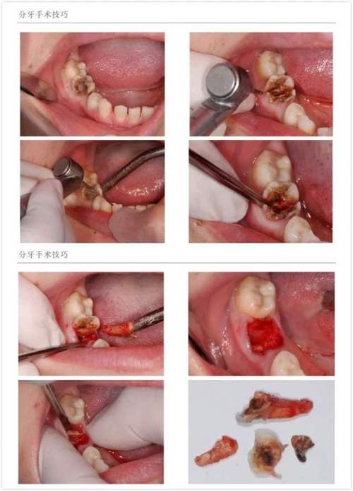 拔牙救急牙根拔一次