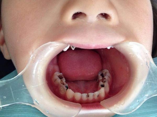 揭秘恒牙龋齿:不仅是口腔问题,还能影响全身健康?