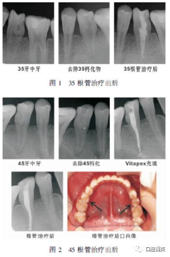 根治牙根尖炎的终极秘籍