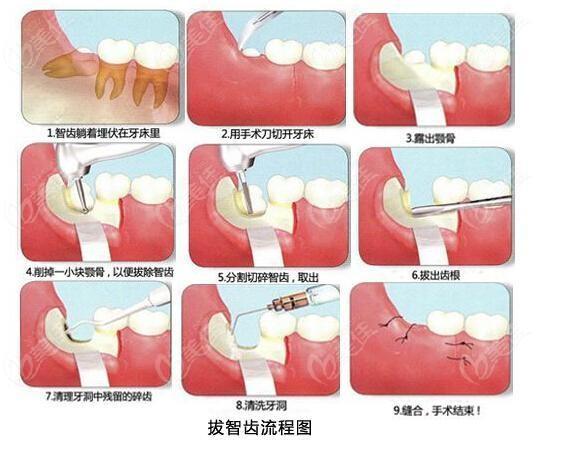 拔牙救急牙根拔一次