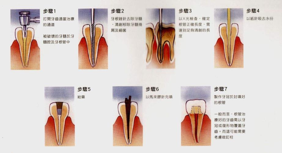 牙髓外露