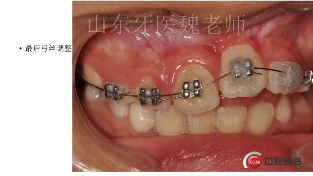 革新正畸牵引断根