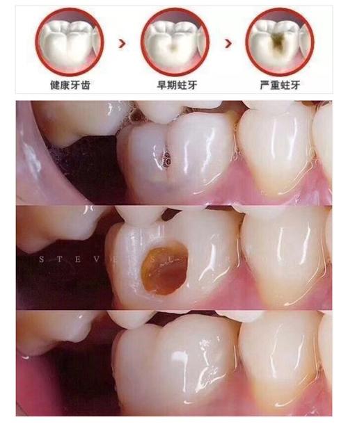 美白健齿误区揭秘浅龋齿补牙后悔