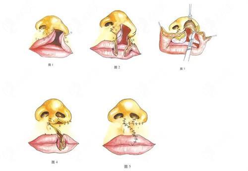 唇腭裂修复手术哪家医院好