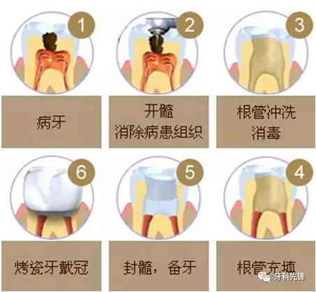 活髓拯救牙齿