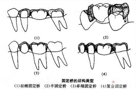 口腔固定桥名词解释