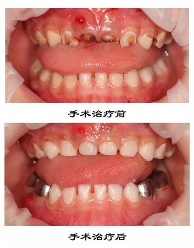 牙槽骨外翻矫正多少钱