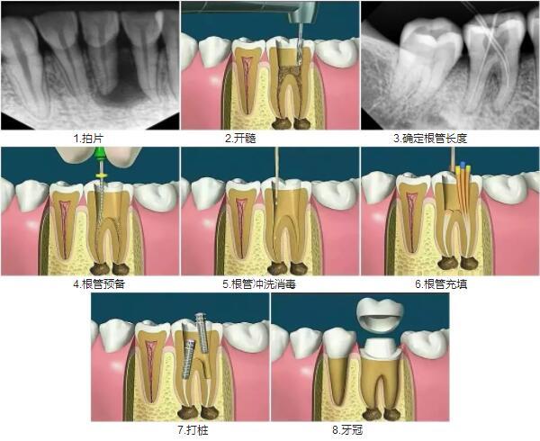 牙根管治疗过程图解