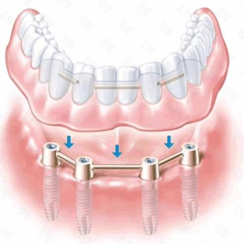 全口假牙种植牙