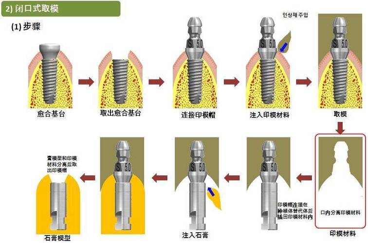 微创种植牙齿带基台