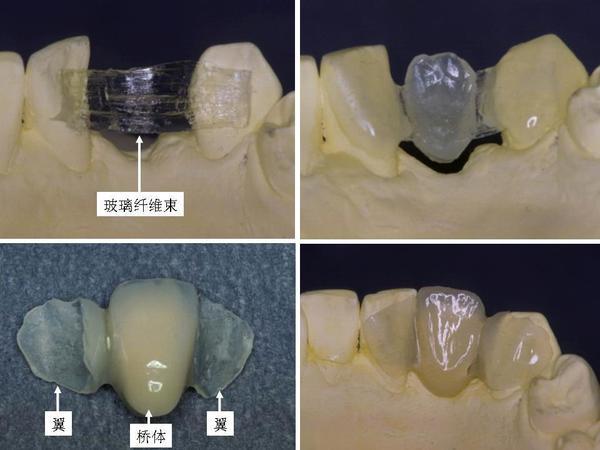 固定桥牙齿出问题