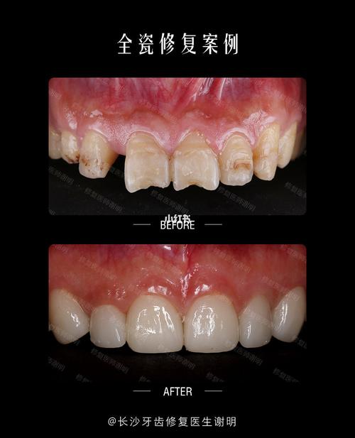 二氧化全瓷牙冠