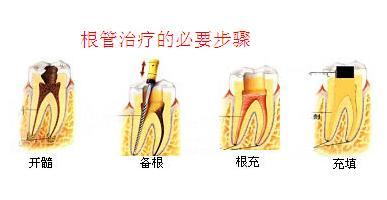 牙根补牙过程图解—从空洞到完美牙齿