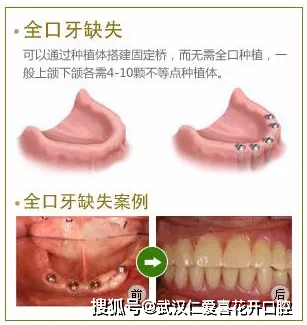 无牙颌种植即刻修复流程