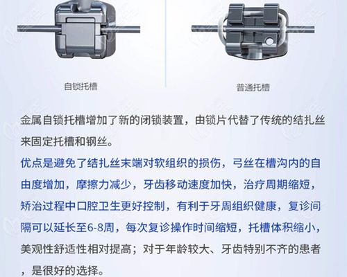 国产金属自锁托槽多少钱