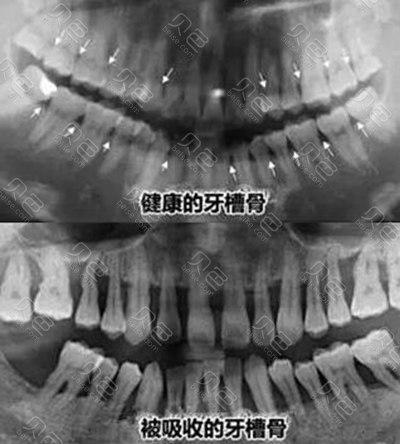 骨粉填充牙槽骨后