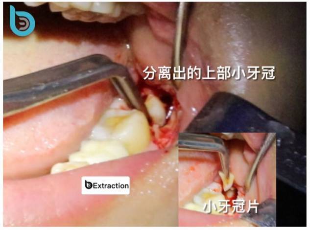 拔牙也能拍电影