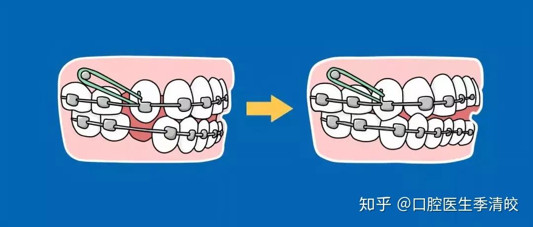 正畸微管粘接方法—微管神奇变身正畸新法震撼来袭