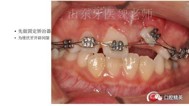 革新正畸牵引断根