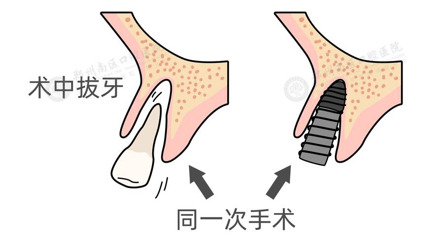 种牙微创手术要多久